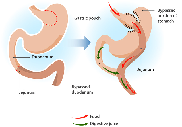 Gastric bypass - Bariatric Advantage Europe